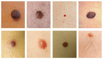 The most common spots on the skin – this is birthmarks and papillomas (warts)