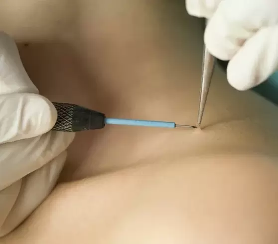 Papilloma removal by electrocoagulation. 