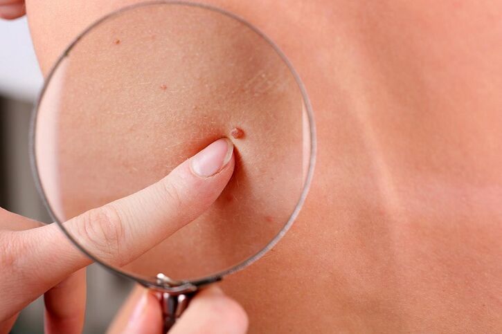 how to remove a wart on the face
