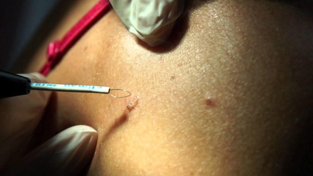 removal of radio waves from papilloma