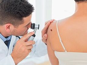 the doctor examines the papilloma and recommends its removal with medications