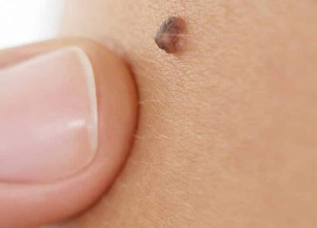 papilloma on the body why does it appear