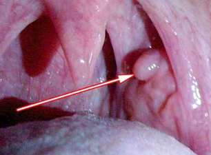 Papilloma in the larynx