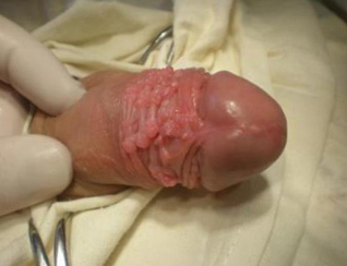 Papilloma on the penis