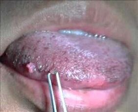 human papilloma virus on the tongue