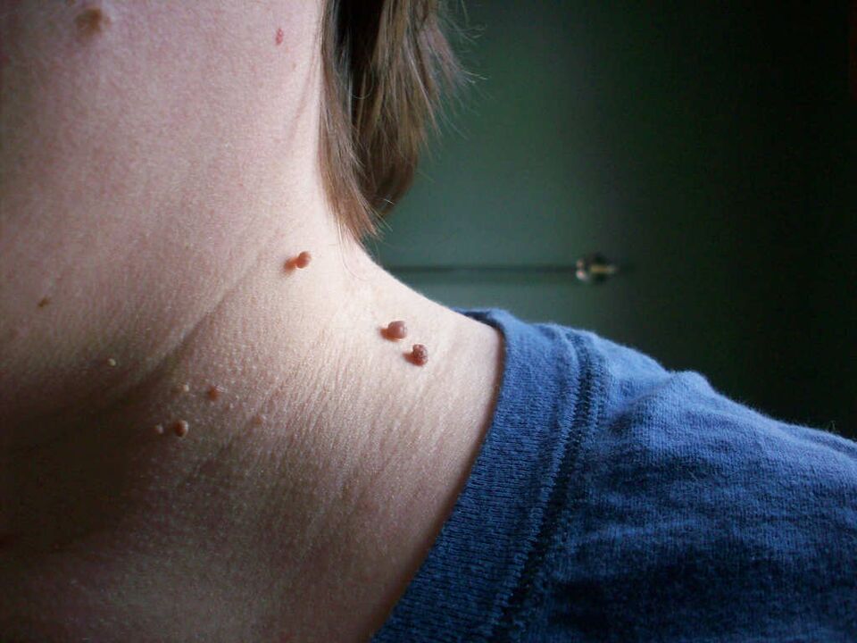 papillomas on the neck how to treat