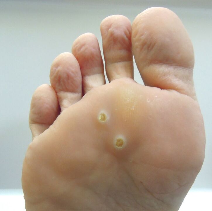 How to get rid of the wart on foot. 