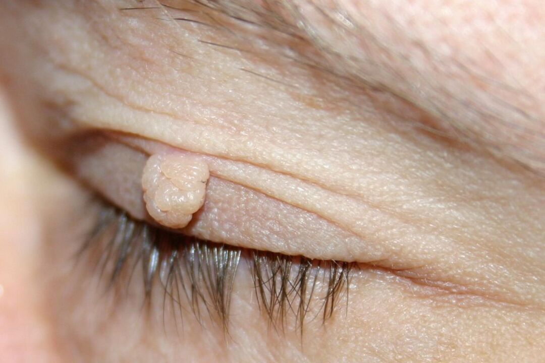 papilloma symptoms on the eyelid