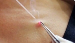 Removal of papillomas on the body with laser. 