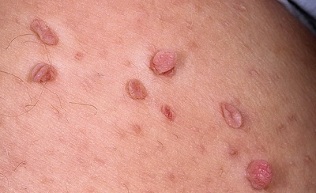 the reasons for the appearance of papillomas on the body