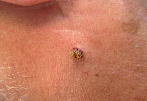 Papilloma on the neck